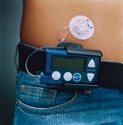 Médicos pedem comparticipação das bomba de insulina Diabetes tipo 1 é a doença crónica pediátrica mais prevalente