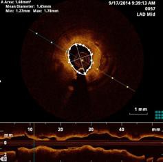 Doenças Cardiovasculares: Investigadores da Universidade de Coimbra Desenvolvem modelo matemático para simular a libertação de fármacos dos Stents de última geração
