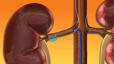 Hospital de Santa Maria Técnica pioneira para tratar doentes com hipertensão arterial